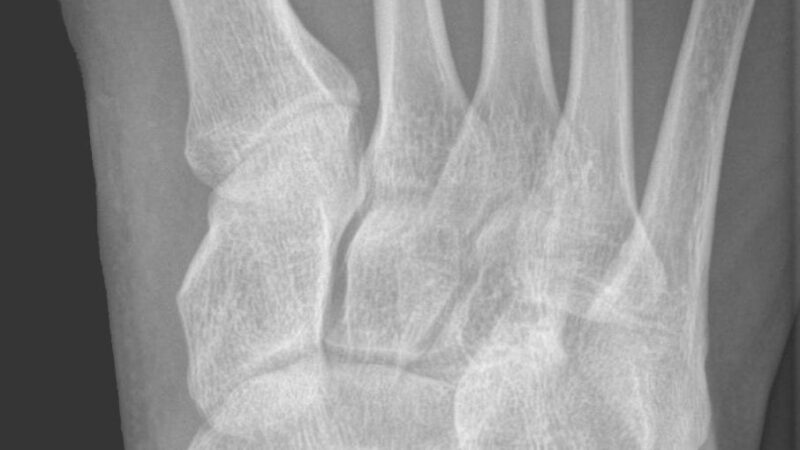 Classification of an Accessory Navicular