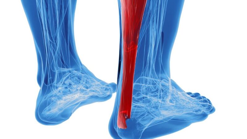 Researchers recommend early walking in a brace for Achilles tendon rupture