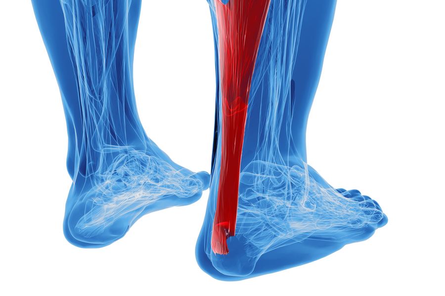 Researchers recommend early walking in a brace for Achilles tendon rupture
