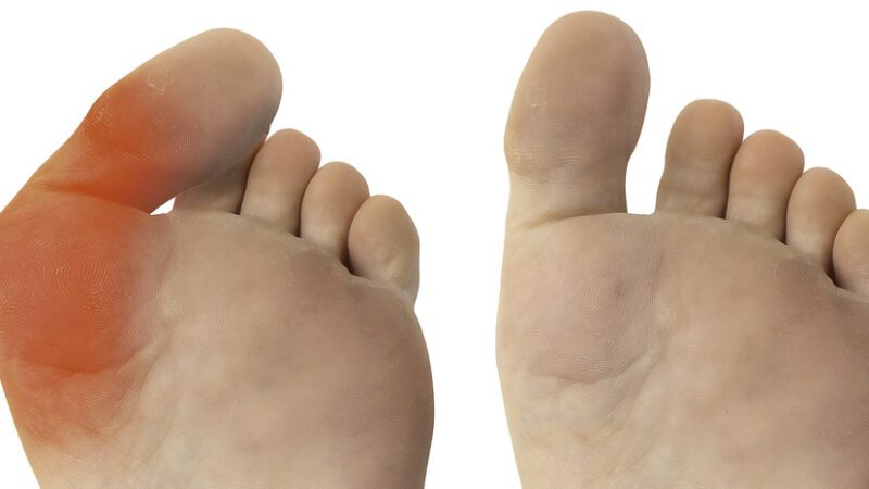 After bunion surgery, immediate x-rays predict recurrence risk