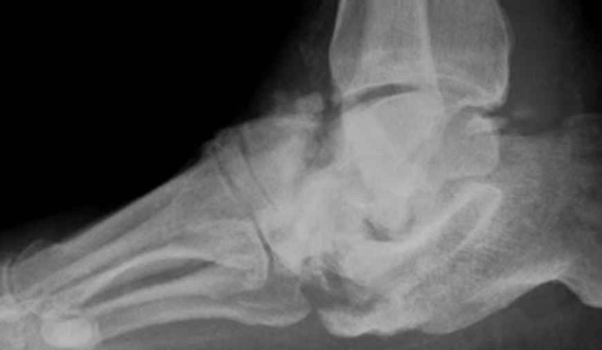 High success rate reported for diabetic Charcot foot surgery