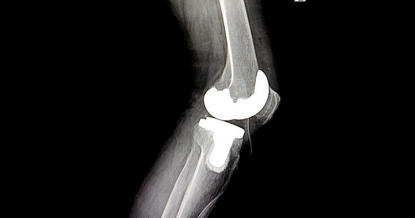 Study finds cementless knee replacement outcomes comparable to standard knee implant