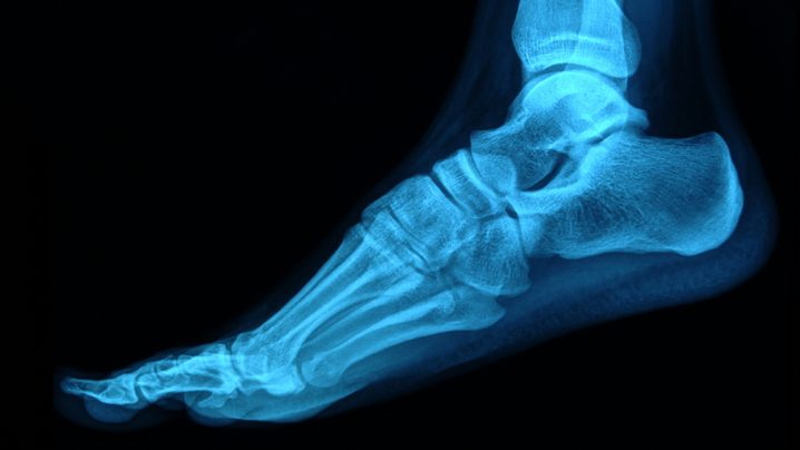Where does a navicular stress fracture hurt?