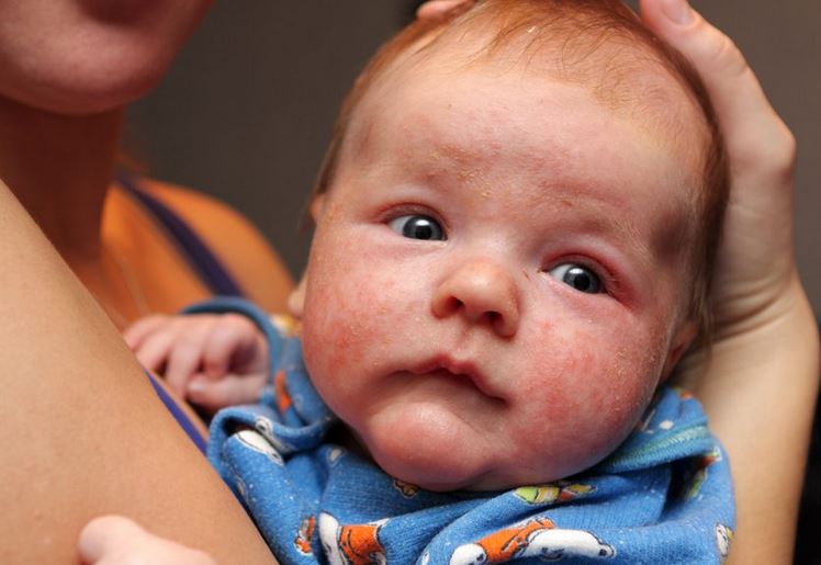 Taking Vitamin D during pregnancy could lower the risk of eczema in babies